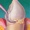Cavities