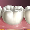 Gum Disease